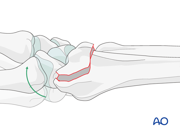 orif dorsal plate