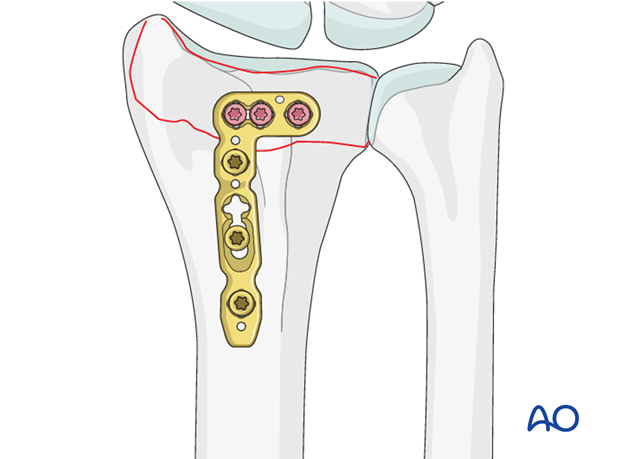 partial articular simple fracture of the radius involving the dorsal rim