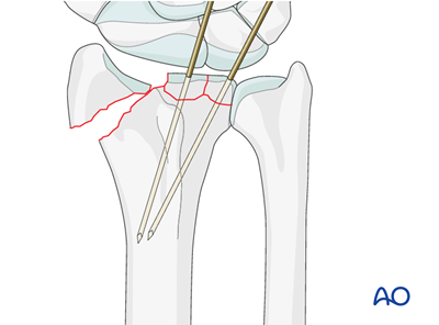 ORIF - Dorsoradial double plate for Partial articular, fragmentary ...