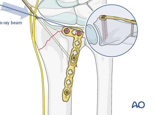 orif dorsoradial double plate