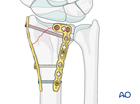 partial articular fragmentary fracture of the radius involving dorsal rim