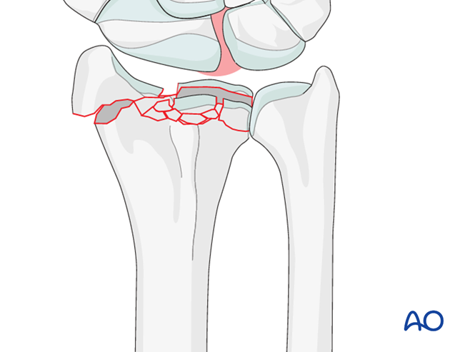 ORIF - Dorsoradial double plate for Partial articular fracture of the ...