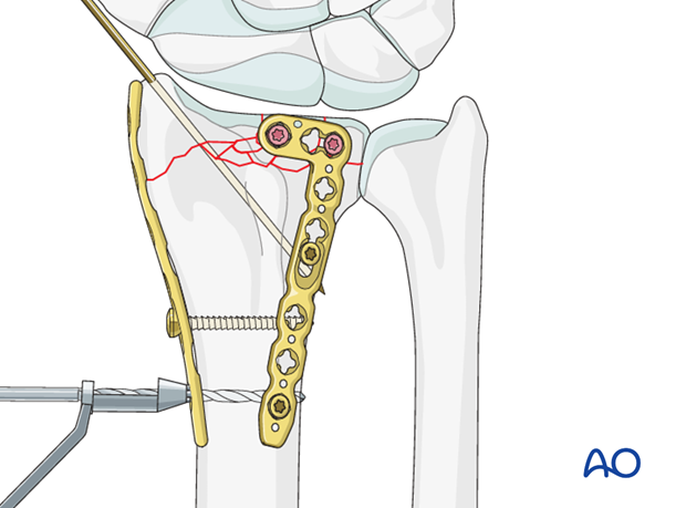 orif dorsoradial double plate