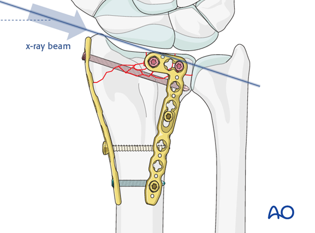 orif dorsoradial double plate