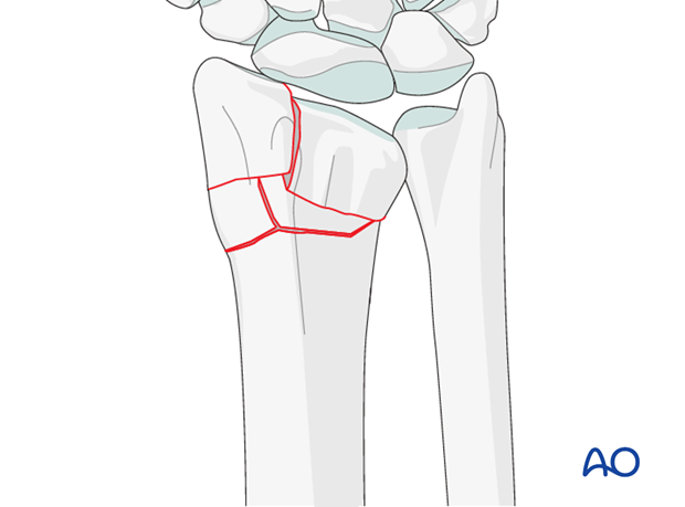 orif dorsoradial double plate