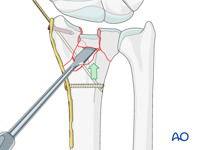 ORIF - Dorsoradial double plate for Complete multifragmentary fracture ...