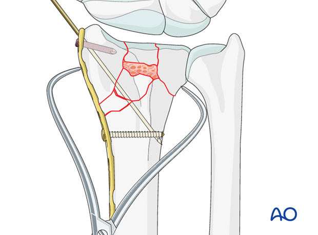 orif dorsoradial double plate