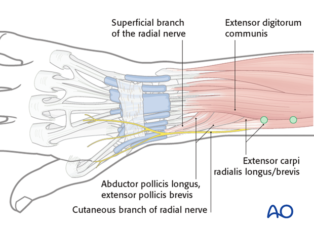 joint spanning external fixation temporary or definitive