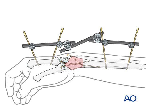 joint spanning external fixation temporary or definitive