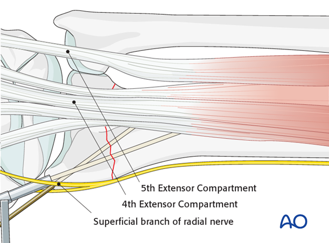 Closed reduction - K-wires and cast/external fixator for Extraarticular ...