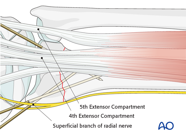 closed reduction k wires and cast external fixator