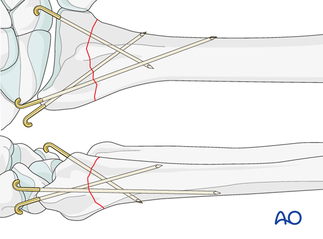 Closed Reduction K Wires And Cast External Fixator For Extraarticular