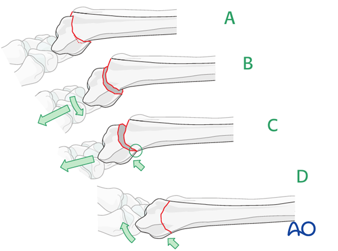 Closed Reduction K Wires And Cast External Fixator For Extraarticular