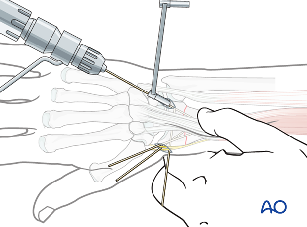 closed reduction k wires and cast external fixator