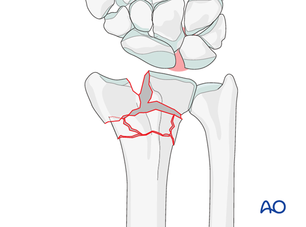 closed reduction k wires and cast external fixator