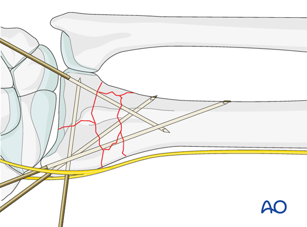 closed reduction k wires and cast external fixator