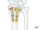 partial articular fracture of the radius with dorsal dislocation