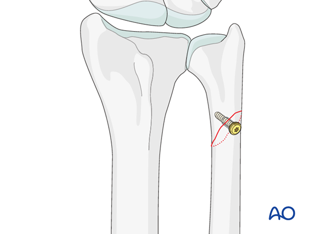 orif lag screw and protection plate