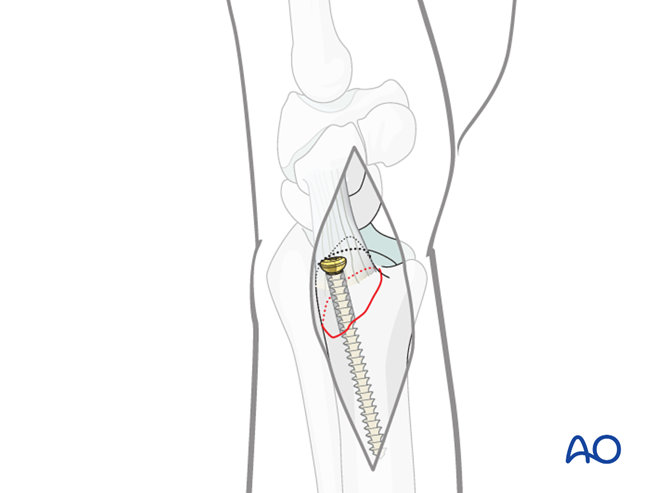 Orif Lag Screw For Extraarticular Fracture Of The Ulnar Styloid Process 