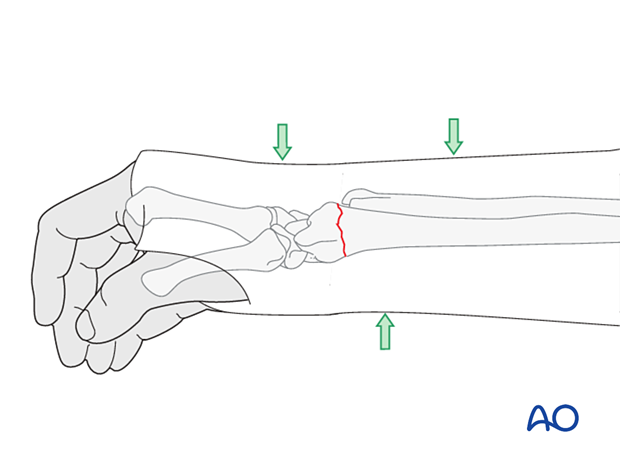 This is normally achieved by applying three-point fixation in the directions specific for that fracture pattern.