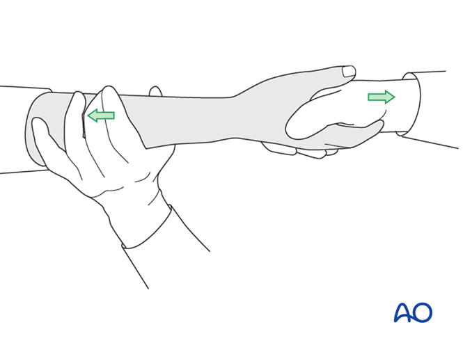 Nonoperative treatment - Cast for Partial articular, sagittal ...