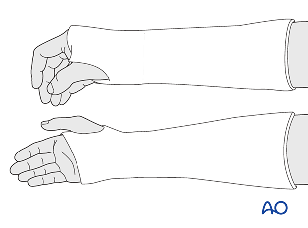 The wrist should be in neutral axial alignment or slight volar angulation.