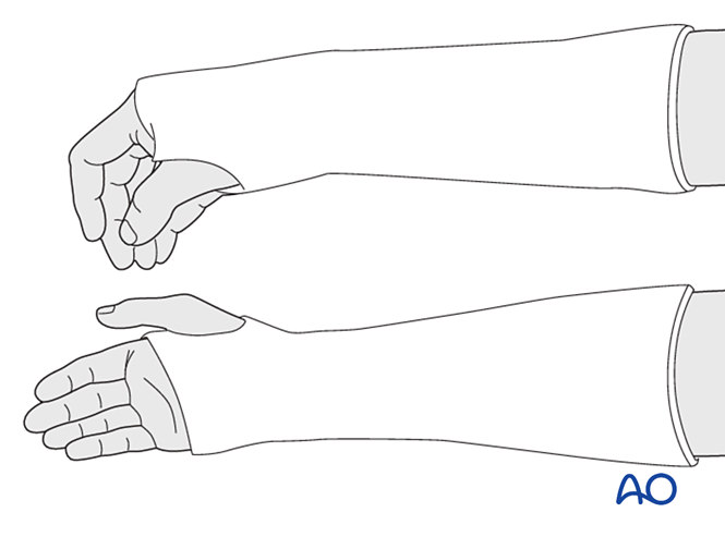 Nonoperative treatment - Cast for Partial articular, simple fracture of ...