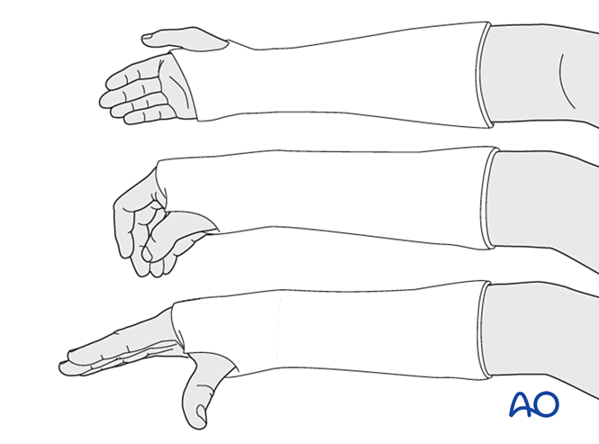 Nonoperative treatment - Cast for Partial articular, simple fracture of ...