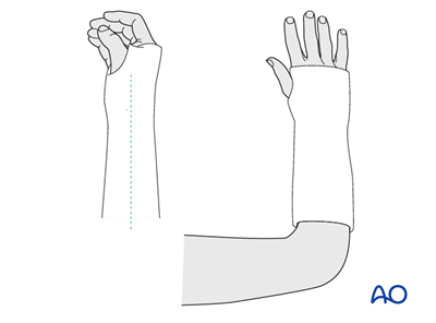 Nonoperative treatment - Cast for Extraarticular simple fracture of the ...