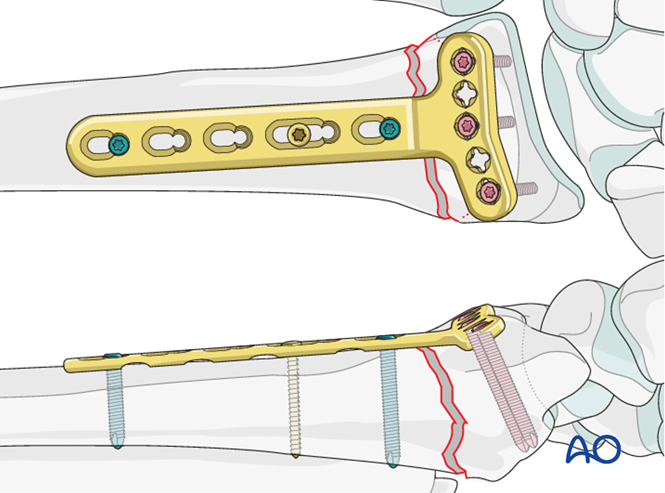 ORIF - Palmar plate for Extraarticular undisplaced fracture of the radius