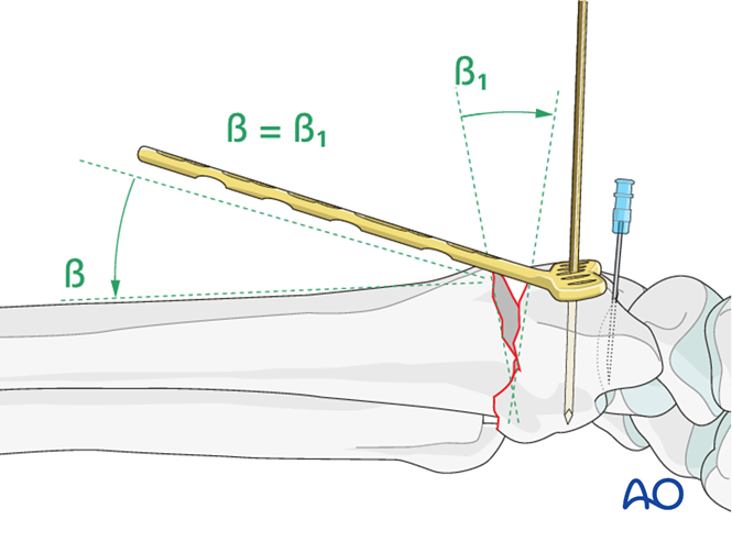 ORIF - Palmar plate for Extraarticular fracture of the radius with ...