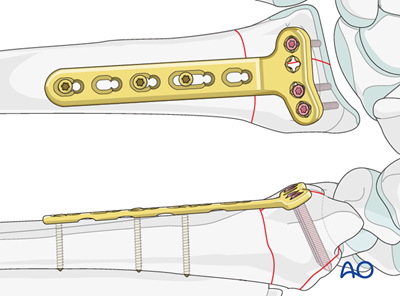 ORIF Palmar plate for Complete simple articular simple metaphyseal