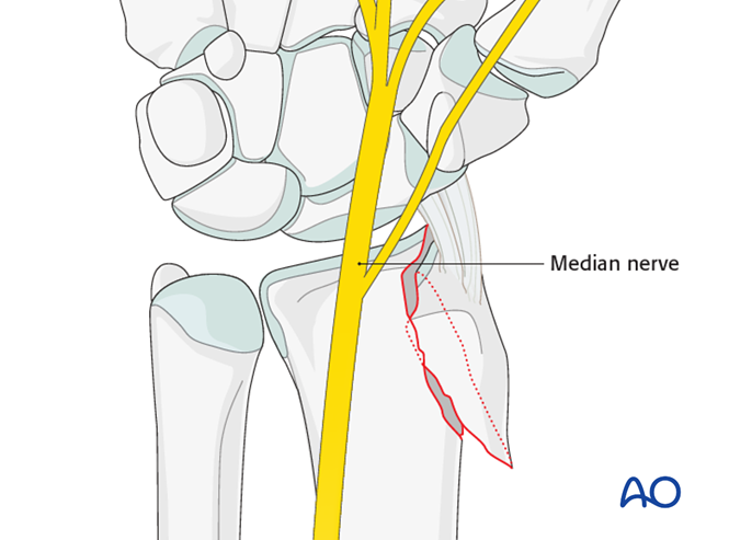 ORIF - Palmar plate for Partial articular, sagittal simple radial ...