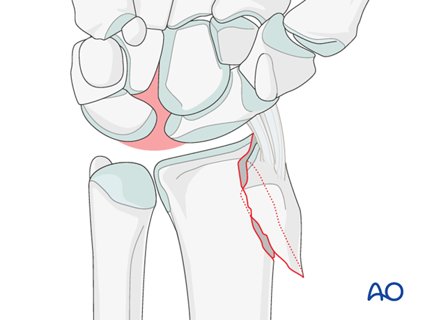 orif palmar plate