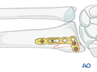 partial articular sagittal simple radial fracture involving scaphoid fossa