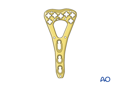 Partial Registration Rim ORIF - Palmar plate for Partial articular fracture of the radius ...