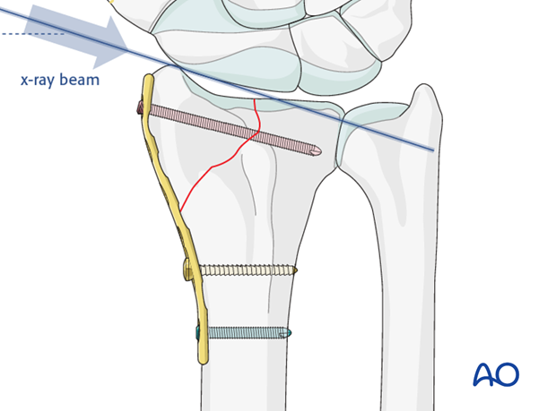 partial articular sagittal simple radial fracture involving scaphoid fossa