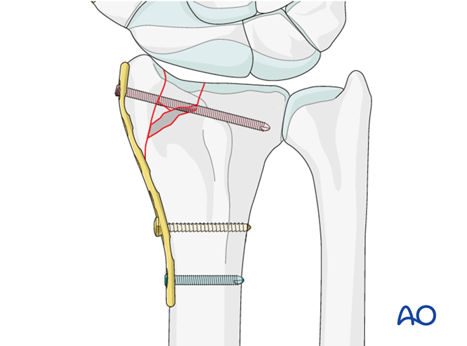 ORIF - Radial column plate for Partial articular, sagittal ...