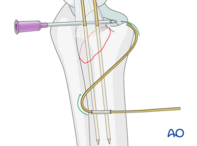 ORIF - Tension band wire for Extraarticular fracture of the ulnar ...