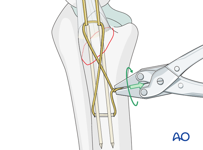 ORIF - Tension band wire for Extraarticular fracture of the ulnar ...