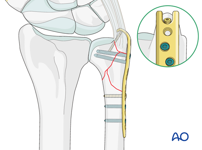 ORIF - Hook plate for Extraarticular multifragmentary fracture of the ulna