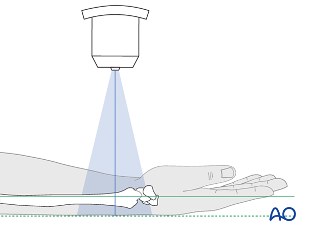 Positioning of the forearm and wrist for optimal AP view