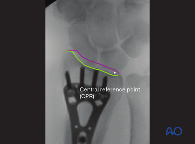 Central reference point (CRP) in an AP view of the distal forearm