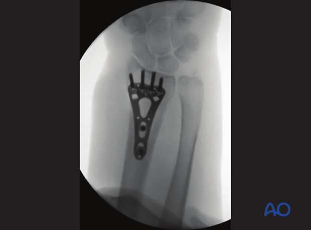 Distal forearm and wrist in AP view with plate fixation