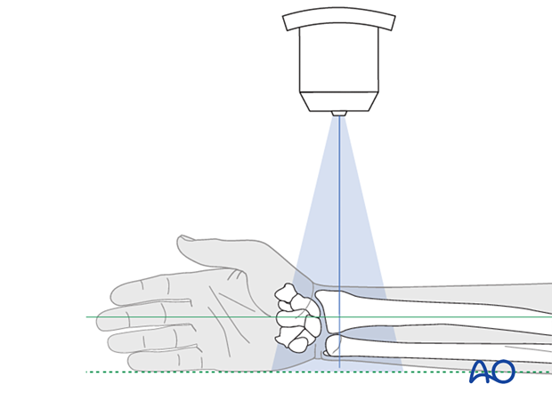 Positioning of the distal forearm and wrist for optimal lateral view 