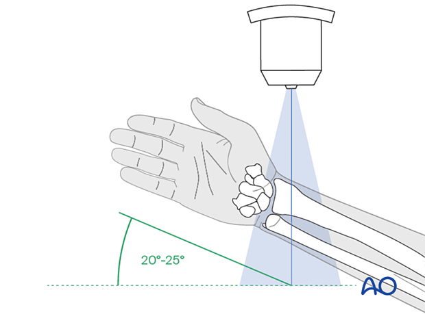Positioning of the distal forearm and wrist for optimal lateral tangential view