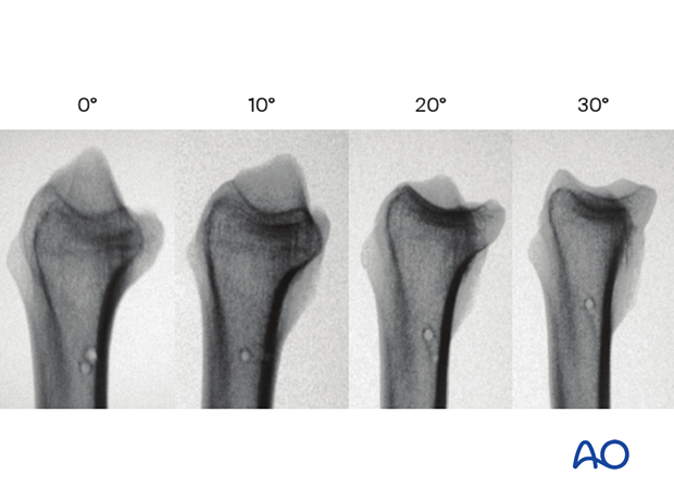 Lateral and lateral tangential views of the radiocarpal joint in different angles