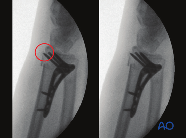 Screw penetration of 2nd compartment seen at the dorsoradial contour of the radial styloid in a dorsoradial view of the distal forearm