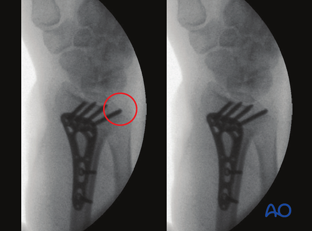 Screw penetration of the 3rd and 4th compartment in a dorsoulnar view of the distal forearm