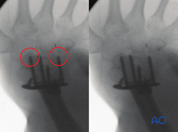 Intraoperative skyline view showing screw penetration of 3rd and 2nd compartment